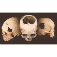 研究的頭顱骨上有鑽洞開顱痕迹。 （邁阿密大學圖片）