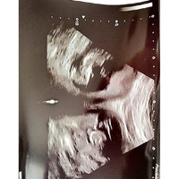 超聲波掃描顯示詹妮弗兩個子宮內，各有一個胎兒在成長。