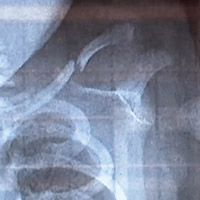 X光片顯示傷勢。