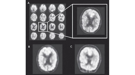 AI系統以深度運算檢測早老性癡呆症患者的腦掃描影像。
