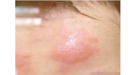 有小童使用退熱貼後額頭出現紅腫。