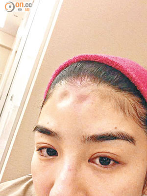 黃奕的額頭凹陷相惹來網民熱烈討論。