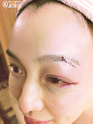 范范左眼眉角捱了25針，眼周圍亦瘀黑晒。