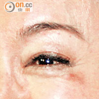 惠英紅左眼角仍留有傷痕。