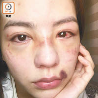 劉燕妮被打到雙眼布滿血絲，嘴角和臉龐均瘀青一片。