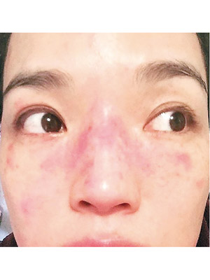 舒淇近年受皮膚敏感困擾，面部經常一片紅腫。