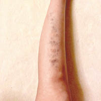 蔡卓妍的美腿瘀晒，睇見都戥佢痛。