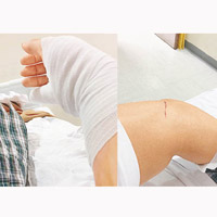 郭子豪的手部縫了廿針，手肘亦遭割傷。