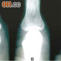 Ａ圖顯示患者關節柔軟組織腫脹但沒有損壞，Ｂ及Ｃ圖顯示關節出現輕微損壞。
