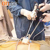 單孔腹腔鏡手術只須開啟一小孔，整套儀器可放於同一孔內。