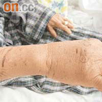 一名老婦被青竹蛇咬傷右手後，即出現腫脹。
