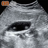 從腹部超聲波影像可清楚看到患者膽囊內有凸起異物，其中黏附膽囊壁的為膽囊息肉。