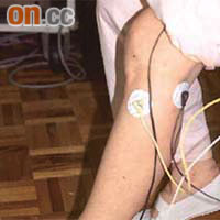 在傷者雙腳上貼上電極貼，通過電流刺激傷者的肌肉，可助他們步行。