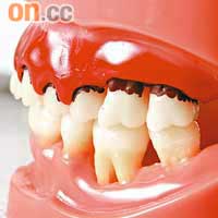 牙周病是香港普遍的牙患，預防和控制是學習重點之一。