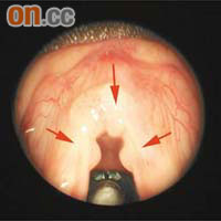 HPV可令喉嚨及聲帶等長出疣，形成凹凸不平的組織（箭嘴示）。