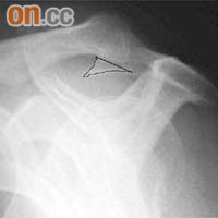 X光影像顯示患有肩峰撞擊綜合症人士，其肩膊長出尖刺狀的新骨（橙色三角示）。