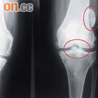 剝落的軟骨會「匿藏」在骨骹之間（紅圈示），透過X光檢查便能顯示出來。