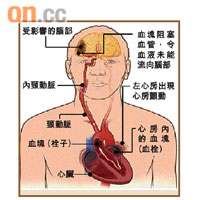 心房顫動患者血液較容易凝結成血塊，若血塊阻塞腦部血管，會令患者中風。