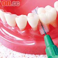 箍牙者須注意口腔衞生，以免令療程受影響。