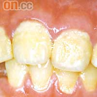 牙肉紅腫是牙周病的初期病徵。