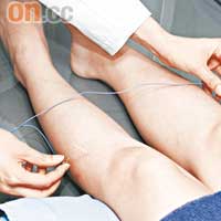 醫師會對足部的「足三里」穴位進行脈衝治療。