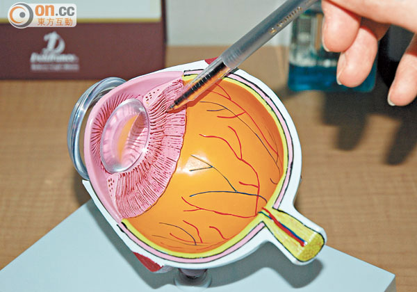 LASIK 鐳射手術 0704-00322-002b6