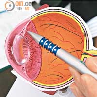 當眼球內房水分泌系統出現問題，超出眼壓所承受範圍，就會引發青光眼。