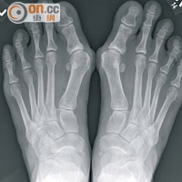 長期穿高踭鞋的女士，很多都有拇趾外翻的苦惱，嚴重者須以手術矯治。