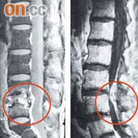 脊椎受感染患者的磁力共振影像顯示，患者的脊椎管內含膿（紅圈示）。