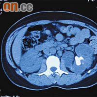 電腦掃描顯示黃小姐的左腎長有「鹿角石」（箭嘴位置）。