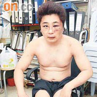 原告馮燦雄指控遭警方毆打，早前展示膝蓋傷勢。其左眼亦因內出血而變紅。	（資料圖片）