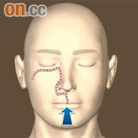 揭面手術將病人眼下及鼻側的整個面頰組織切開，讓醫生清楚看到腫瘤及施行手術。	（設計圖片）