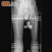 病人在雙腿的股骨和脛骨進行增高手術，完成手術的Ｘ光圖像。	（香港醫學雜誌圖片）
