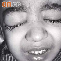 巴籍男童接受斜視矯正手術後，右眼感染細菌致腫脹，無法睜大。	（香港醫學雜誌黑白圖片）