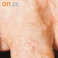汗疱皮炎患者的指間會出現小水泡，十分痕癢。	（受訪者提供圖片）