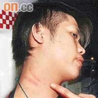 慘遭打穿耳膜的兄長「阿謙」頸上仍留下被叉頸的傷痕。