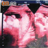 鄭小姐的胎兒照超聲波時，胎兒身體非常健康。（受訪者提供）