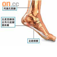 足底筋膜炎患者的筋膜因過度勞損而發炎，會感到腳跟部位疼痛。