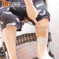 長者骨骼脆弱，一旦跌倒受傷並有骨折，傷口需打石膏或套上腳托穩定傷口。 （資料圖片）