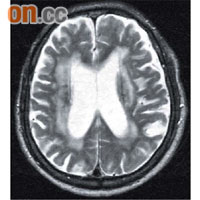 磁力共振檢查顯示血管性癡呆症患者腦部出現血管栓塞。