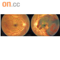 老年黃斑病可引致患者失明。