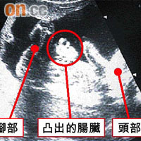 超聲波影像顯示胎兒的肚皮破裂，腸臟凸出。	（超聲波影像）