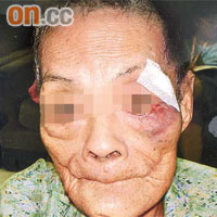 連老太在院舍內無故跌傷，縫合傷口後，面上仍留下大片瘀痕。