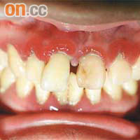 牙齦炎、牙齦紅腫出血等都是牙周病的症狀。	（資料圖片）