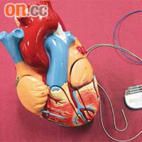 雙心室起搏器有三條電線，分別植入到右心房、右心室及左心室。