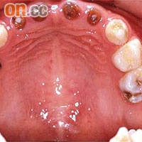 一名患有「奶瓶齒」的兒童上排四隻門牙全部被蛀，只剩下牙腳部分。