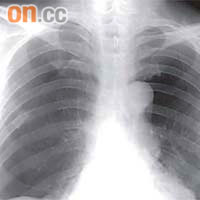 X光檢查有助診斷氣胸，檢視患者肺部的漏氣情況。	（資料圖片）