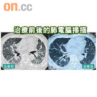 電腦掃描顯示，肺纖維化病人肺部呈灰白色。