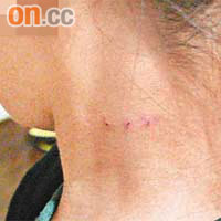 女童頸上留有傷痕。