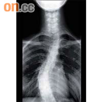 X光顯示脊柱側彎患者的脊骨呈「S」形。